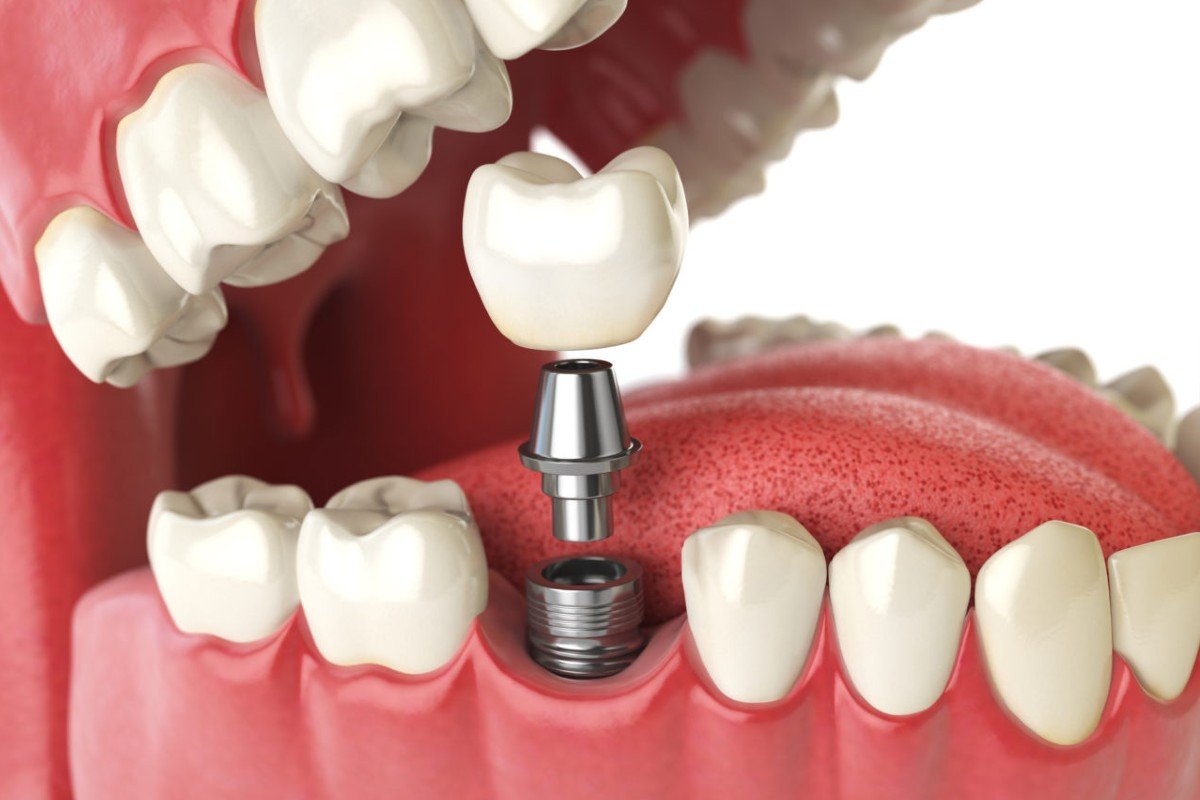 Single Tooth Dental Implant in India